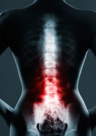 Spinal Cord Personal Injury Damages